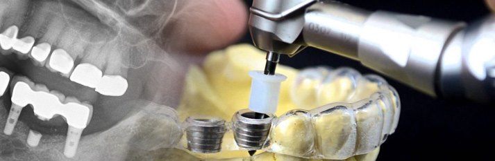 Premium quality dental implants in Greece