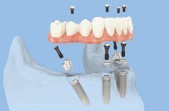 full dental restoration