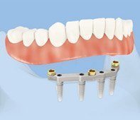 Denture on implant bar anchored by four implants